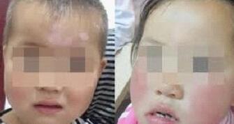 武汉儿童脸部长有白癜风该怎么办
